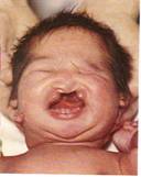 Patau Syndrome Patau (1).jpg